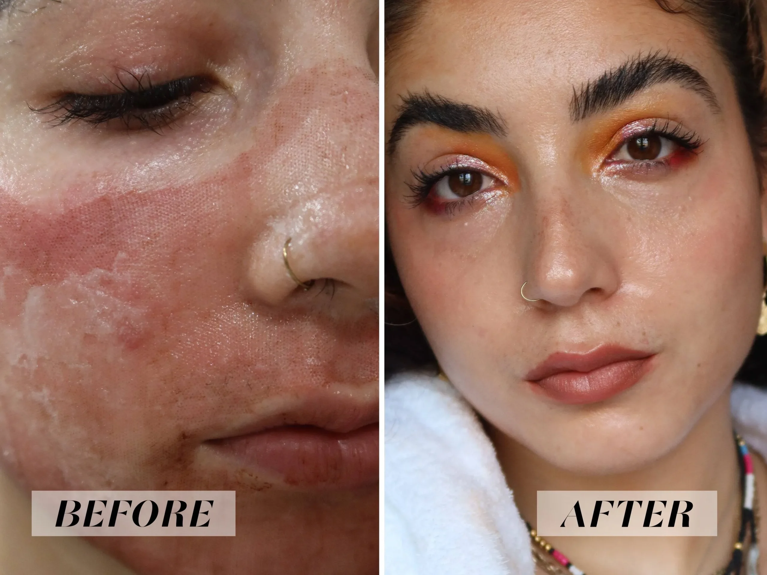 Is CO2 laser resurfacing worth it for deep wrinkles and scars